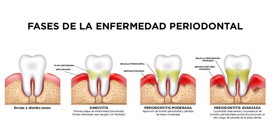 Piorrea, periodontitis tratamiento, gingivitis, enfermedad periodontal